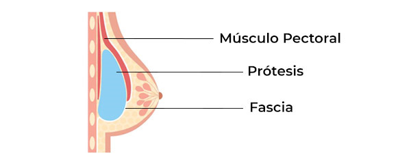 Colocación implante mamario en el plano dual