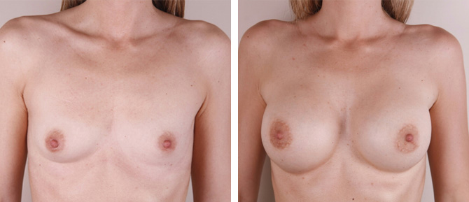 Caso de Estudio 1: paciente con Hipoplasia mamaria severa en Zaragoza