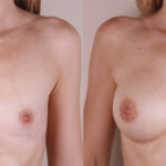 Caso de estudio: Corrección de Hipoplasia Mamaria Severa con un Aumento Mamario