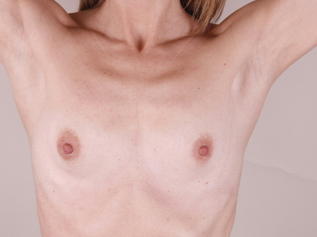 Antes de aumento de pecho, caso de hipoplasia mamaria severa