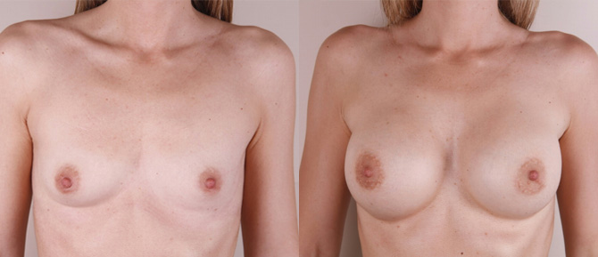 Caso de estudio: Corrección de Hipoplasia Mamaria Severa con un Aumento Mamario