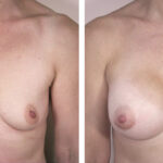 Caso de Estudio 2: paciente con Poco volumen mamario y ptosis en Zaragoza