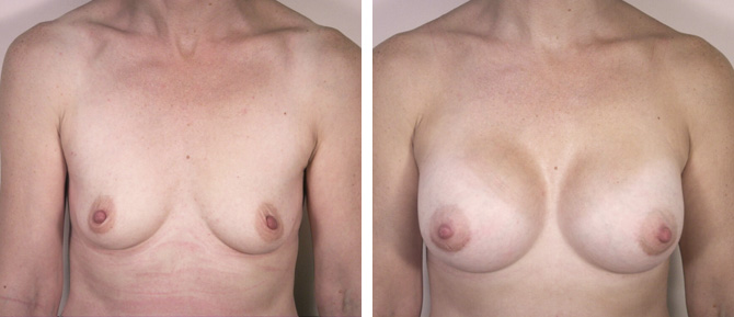 Caso de Estudio 2: paciente con Poco volumen mamario y ptosis en Zaragoza