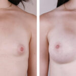 Caso de Estudio 3: paciente con Poco volumen mamario y mama tuberosa en Zaragoza