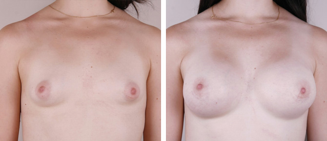 Caso de Estudio 3: paciente con Poco volumen mamario y mama tuberosa en Zaragoza
