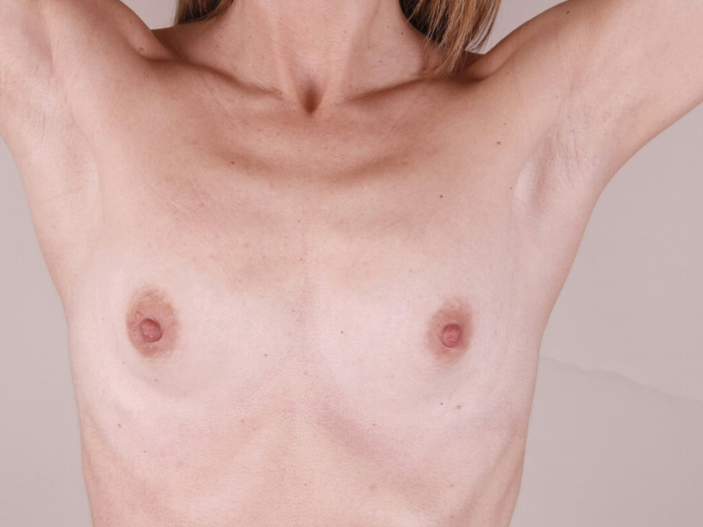 Caso de estudio: Corrección de Hipoplasia Mamaria Severa con un Aumento Mamario en Zaragoza | Antes Frontal Brazos