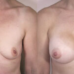 Caso de Estudio 2: Poco volumen mamario y ptosis en Zaragoza