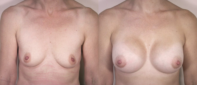 Caso de Estudio 2: Poco volumen mamario y ptosis en Zaragoza