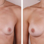 Caso de Estudio 4: paciente con Hipoplasia mamaria con asimetría en Zaragoza