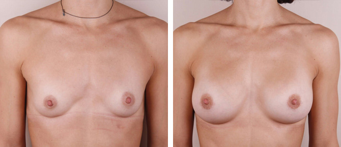 Caso de Estudio 4: paciente con Hipoplasia mamaria con asimetría en Zaragoza