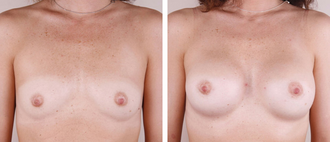 Caso de Estudio 5: paciente con Escaso volumen mamario sin ptosis en Zaragoza