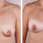 Caso de Estudio 7: paciente con Mama tuberosa con poco desarrollo mamario y areola grande en Zaragoza