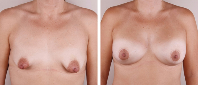 Caso de Estudio 7: paciente con Mama tuberosa con poco desarrollo mamario y areola grande en Zaragoza