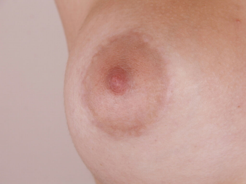 Caso de Estudio 8: Mama tuberosa con areola grande en Zaragoza | Cicatriz Areola Izquierda