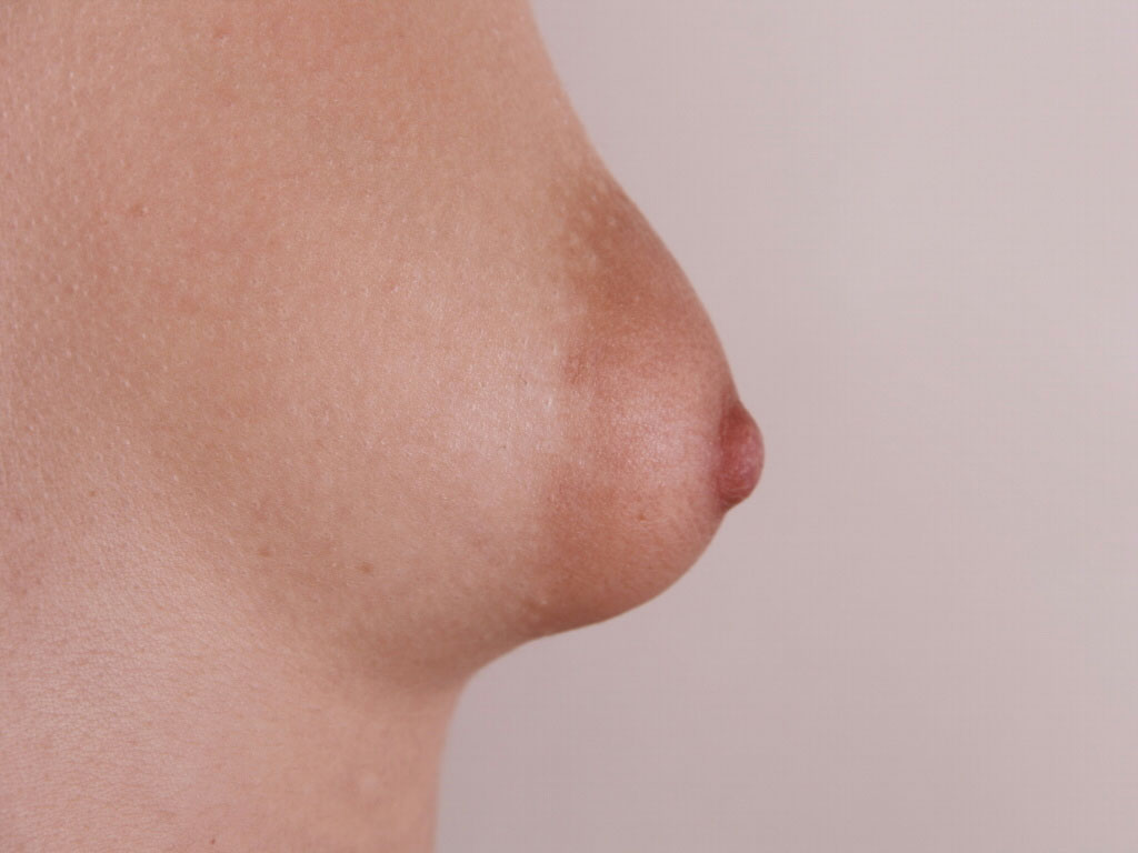 Caso de Estudio 8: Mama tuberosa con areola grande en Zaragoza | Perfil Mama Derecha