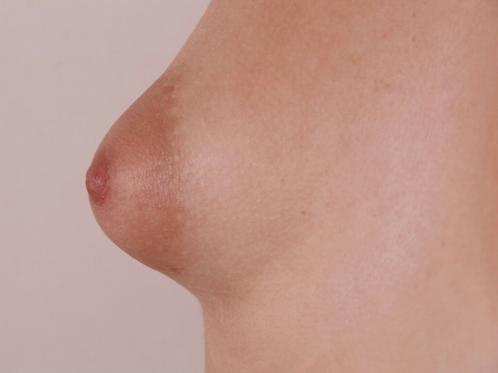 Caso de Estudio 8: Mama tuberosa con areola grande en Zaragoza | Perfil Mama Izquierda