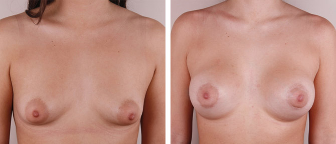 Caso de Estudio 8: paciente con Mama tuberosa con escaso desarrollo mamario y areola grande en Zaragoza