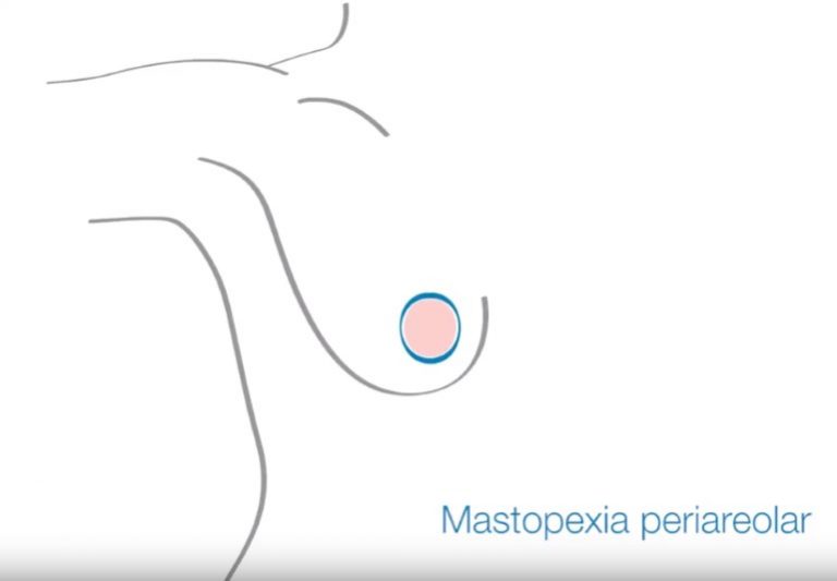 Mastopexia periareolar en Zaragoza