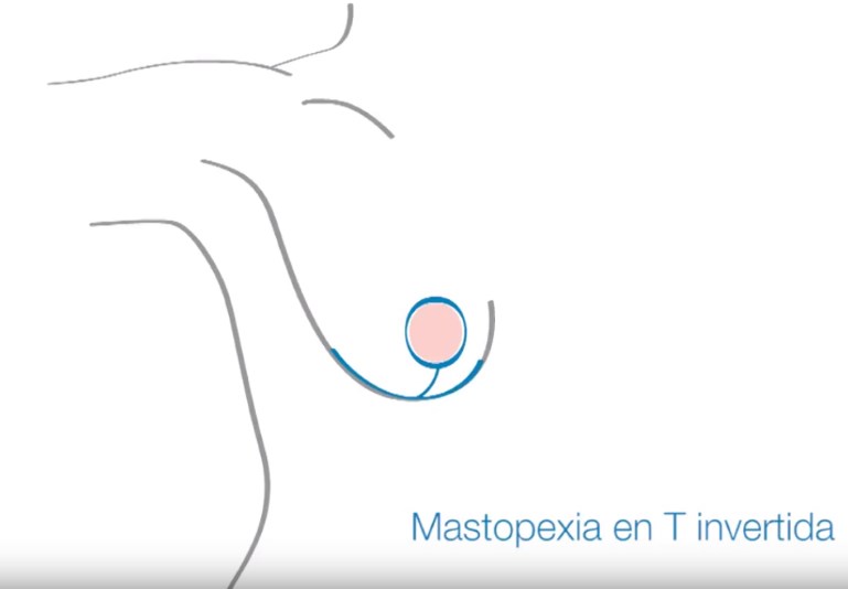Mastopexia en T invertida en Zaragoza