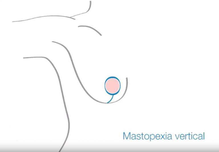 Mastopexia vertical en Zaragoza