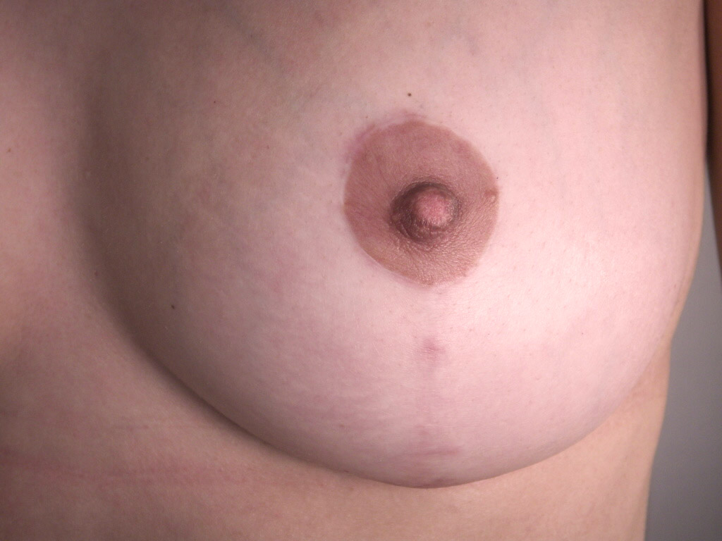 Caso de Estudio 13: Mastopexia T Invertida paciente tras embarazo y lactancia en Zaragoza | Cicatriz en T Invertida Mama Derecha